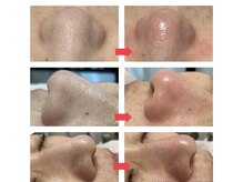 アミューズ 大津駅前PICNIC店(Amyze)/毛穴エクストラクション