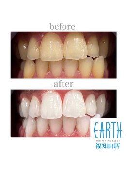 ホワイトニングサロン アース 福知山店(EARTH)/Before&After美白ホワイトニング