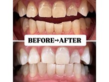 ホワイトニングサロン 豊中/Before&After美白ホワイトニング