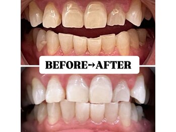 ホワイトニングサロン 豊中/Before&After美白ホワイトニング