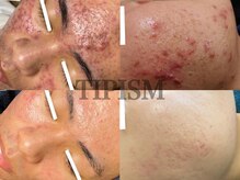 ルノン(Lunon)の雰囲気（結果重視◎本物を求める方へ【ニキビケア】）
