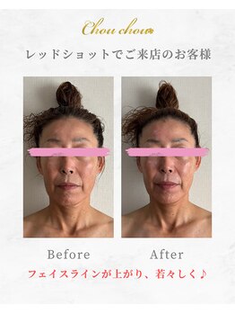 シュシュ(Chouchou)/レッドショット1回