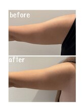 ラディアント(Radiant)/インディバ×レモンボトル