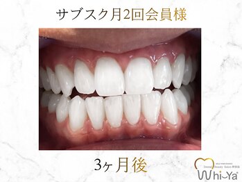 ホワイヤ セルフホワイトニング DBS神楽坂(Whi-Ya)/☆サブスク会員様☆納得の白さ☆