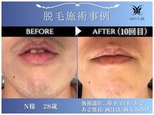 メンズビービー 福井高柳店(MEN'S BB)/ヒゲ脱毛施術事例