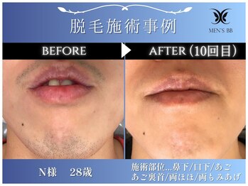 メンズビービー 福井高柳店(MEN'S BB)/ヒゲ脱毛施術事例