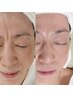 【最短！ハリ艶出現☆小顔調整エステ＋水光ピールコース】回数券お持ちの方¥0