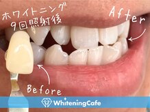 ホワイトニングカフェ 千葉店/ホワイトニング9回照射後＊男性