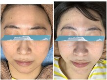 ザ ファーストサロン(The First Salon)/毛穴美白コース