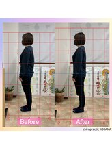 カイロプラクティック コダマ(KODAMA)/ビフォーアフター