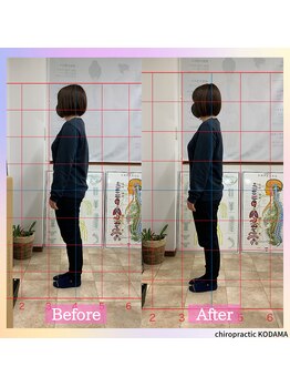 カイロプラクティック コダマ(KODAMA)/ビフォーアフター