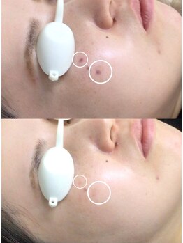 シェアキ(Chez Aki)/シミケアBefore/After