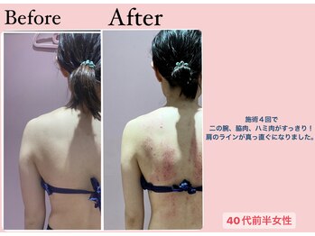じぶんdeエステ 梅田店/CELLZERO.式症例/二の腕背中/4回