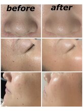 クリスタルボウ(Crystal BEAU)/Elight顔脱毛1回のみ