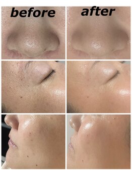 クリスタルボウ(Crystal BEAU)/Elight顔脱毛1回のみ