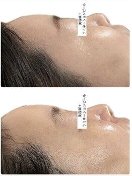 陽月 鍼灸院整骨院/目元の小じわに注目