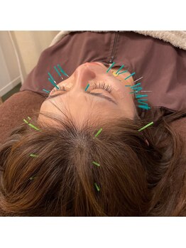 蒼月(aotsuki)/美容鍼