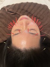 ピュアハリ美容鍼サロン
