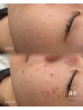 アエ(ae)/シミケア30分当て放題