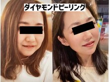 アンド リオール(&RE:ALL)/話題沸騰ダイヤモンドピーリング