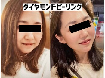 アンド リオール(&RE:ALL)/話題沸騰ダイヤモンドピーリング