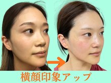ナチュラルビューティーフェイス 横浜(NBF)/面長も改善・小顔/横浜小顔矯正