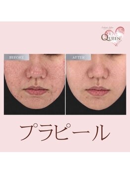 クイーン(QUEEN)の写真/一度で感動！毛穴レスなツヤ肌を実現！お肌のお悩みマルっと解消！！敏感肌でも◎ヘッドスパ付き♪