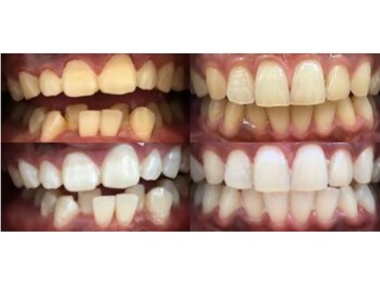 ワイスタイル(Ystyle)/左20代男性/右30代女性　３回後