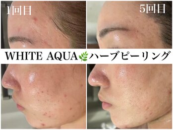 ホワイトアクア 天王寺本店(WHITE AQUA)/ハーブピーリングで肌荒れ改善