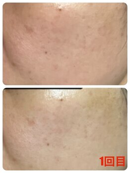 サロンメレ(Salon Mele)/敏感肌にも◎ハーブピーリング