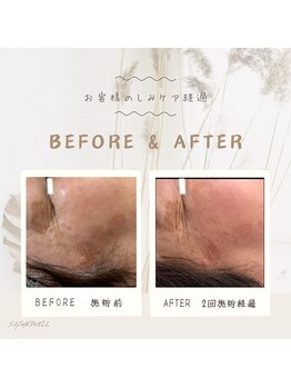 セメヴェール(Saimervell)/シミの根本から改善しましょう☆