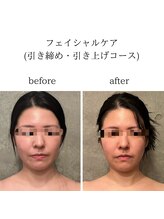 ビノワ(Binowa)/フェイシャルビフォーアフター