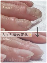 モデラート(moderate)/自爪育成