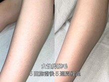 エクレ 柏店(EKURE)/レディース足脚脱毛-脛