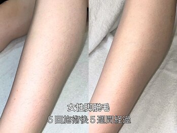 エクレ 柏店(EKURE)/レディース足脚脱毛-脛