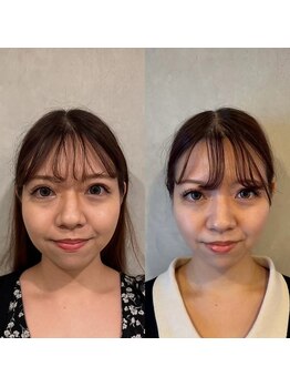 ココロ美容整体院(cocoro)/小顔調整 BeforeAfter
