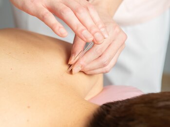 ゆめたか接骨院 鍼灸院 整体院 大沢野院/肩、背中への鍼施術