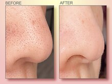 ジュリア オージェ 四条河原町店/ビフォーアフター（鼻スパ）