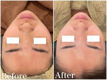 サロンドフェイス(Salon de Faith)/ハーブピーリング