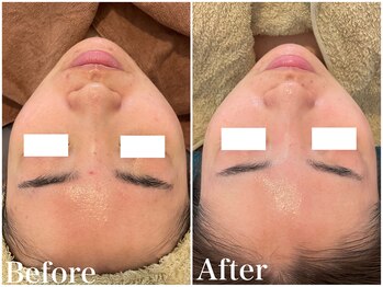 サロンドフェイス(Salon de Faith)/ハーブピーリング