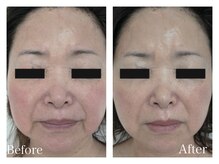 イヨヨ(iyoyo)/BeforeAfter