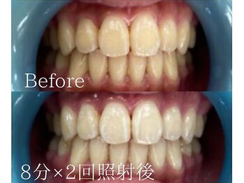 ホワイトニングカフェ 荻窪店(WhiteningCafe)/◎歯のホワイトニング施術写真◎