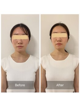 チル(Chill.)/小顔リフト整顔 9