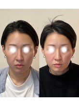 小顔22 ボルティ 赤坂支店(Bolty)/面長＝中顔面が短く