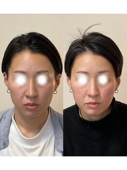 小顔22 ボルティ 赤坂支店(Bolty)/面長＝中顔面が短く