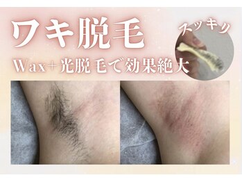 アルゴ 金沢増泉店(ALGO)/アルゴ式ワックス脱毛