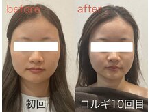 ビーキュート 姫路店(BE-CUTE)/小顔コルギ10回目