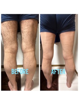 シェービーズ(shavys)/下半身脱毛