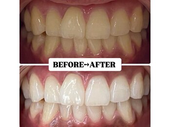 ホワイトニングサロン 豊中/Before&After美白ホワイトニング