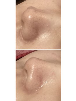 カレン/毛穴洗浄ハイドロフェイシャル